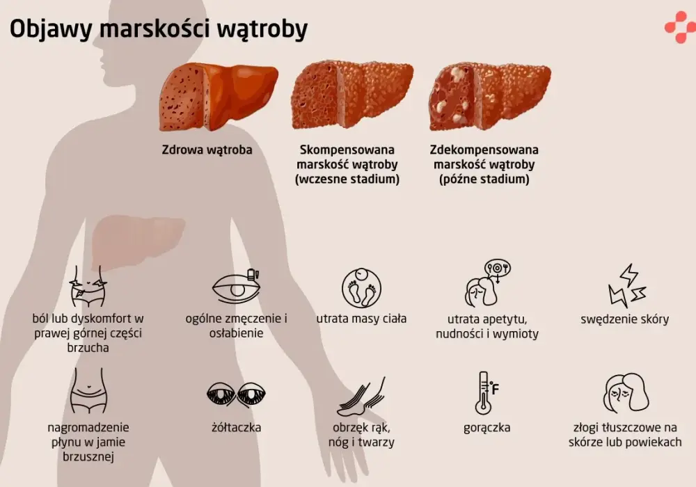 Marskość wątroby - objawy, przyczyny, leczenie. Sprawdź, co musisz wiedzieć!