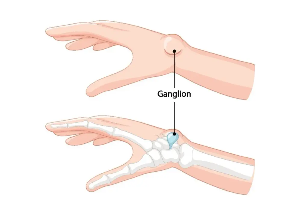 Ganglion twardy jak kość? Rozwiąż zagadkę guzka pod skórą!