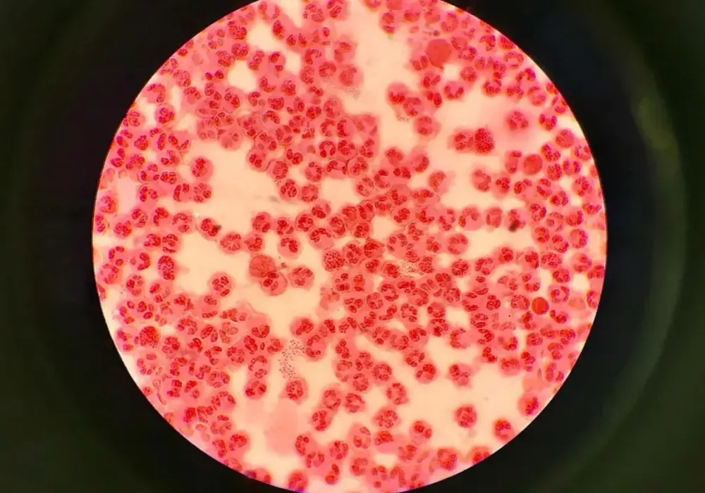 Rzeżączka - Ciche zagrożenie? Objawy, leczenie, diagnostyka
