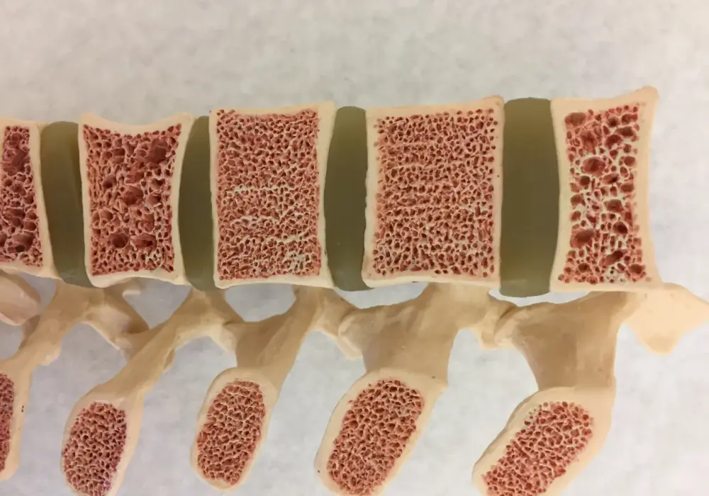 Bisfosfoniany w osteoporozie - jak działają i jak je przyjmować?