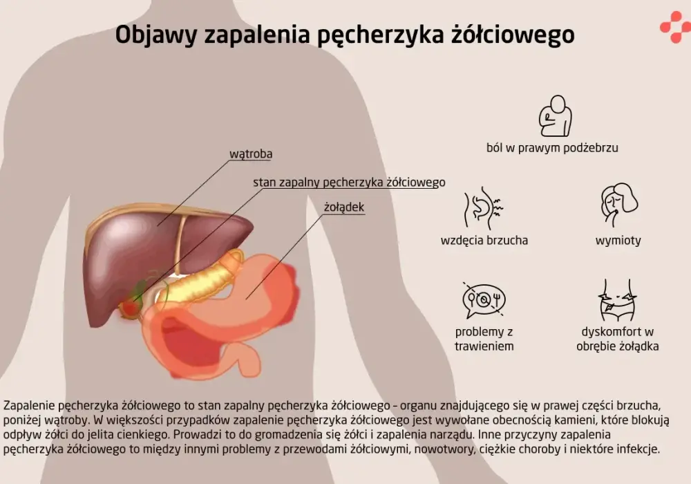Zapalenie woreczka żółciowego - objawy, badania i leczenie