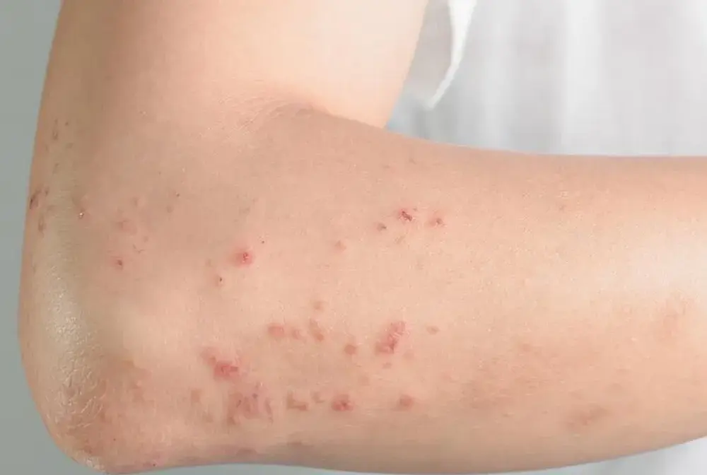 Histamina, alergia czy nietolerancja? Jak rozpoznać różnicę