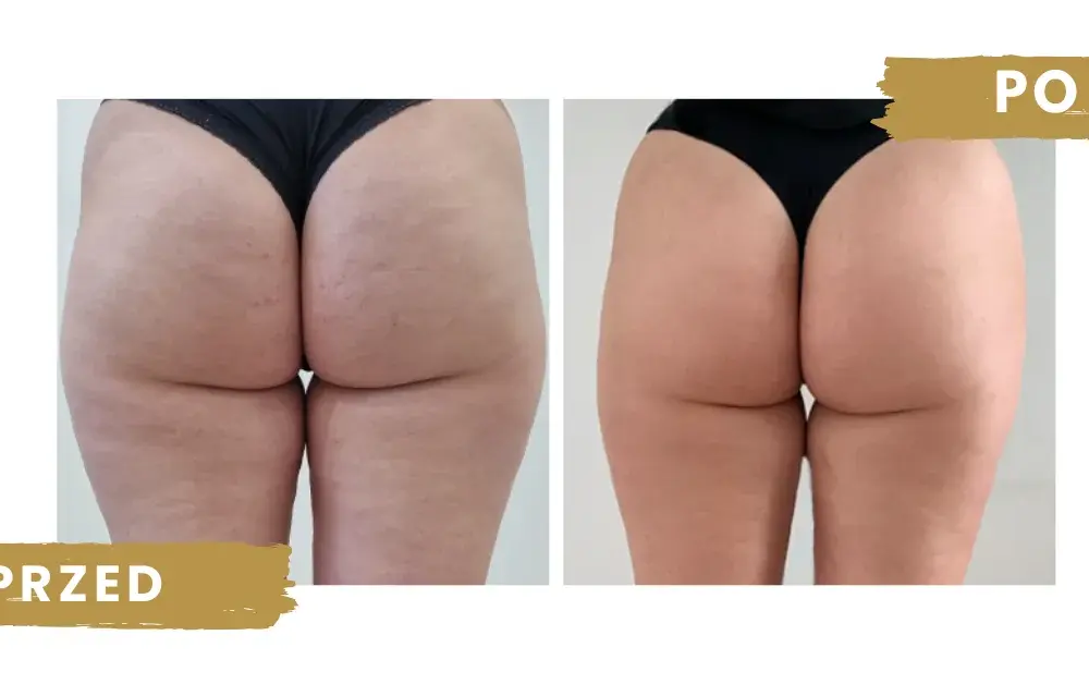 Co daje endermologia? Efekty, które mogą Cię zaskoczyć