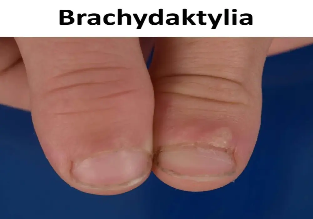Brachydaktylia - Skrócone palce: Cecha czy choroba?