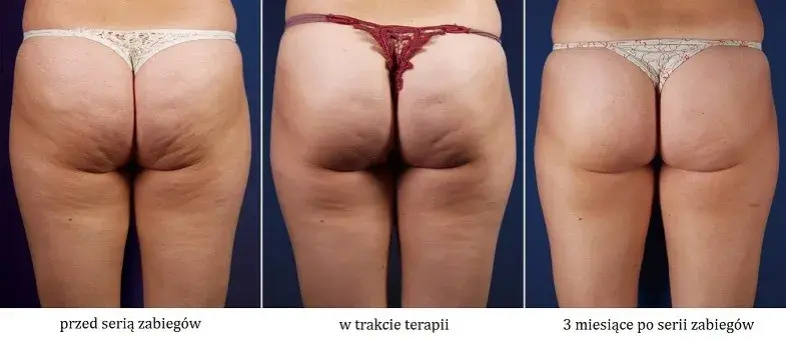 Jakie zioła na cellulit skutecznie redukują widoczność pomarańczowej skórki