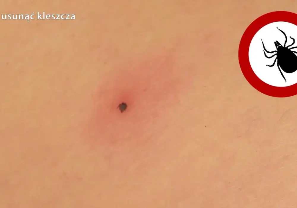 Jak wygląda mały kleszcz? Rozpoznaj go i uniknij niebezpieczeństwa!