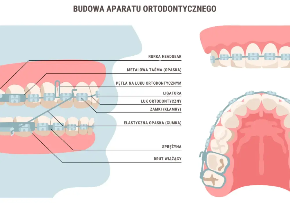 Co przed założeniem aparatu ortodontycznego: kluczowe informacje i kroki do podjęcia