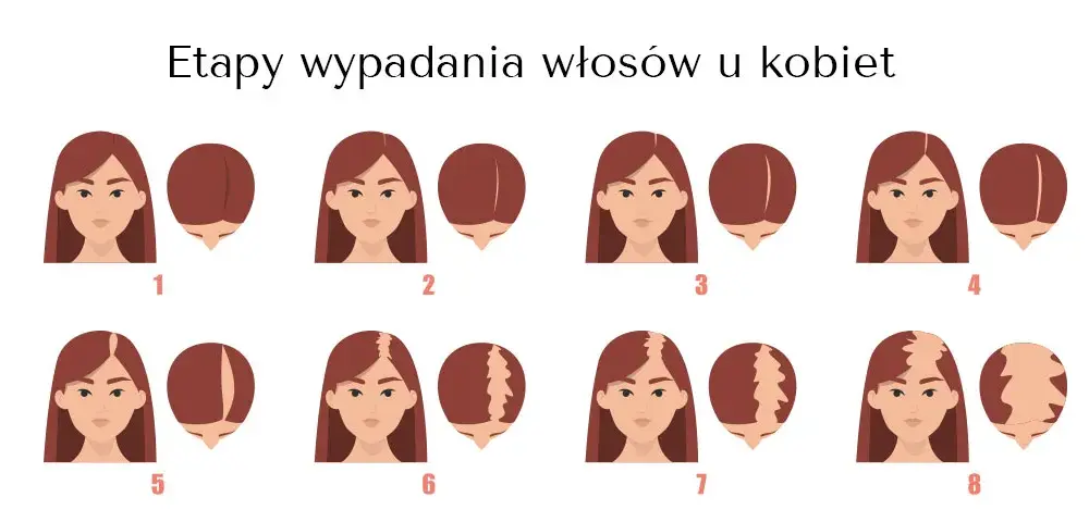 Łysienie androgenowe u kobiet: objawy, przyczyny i wpływ