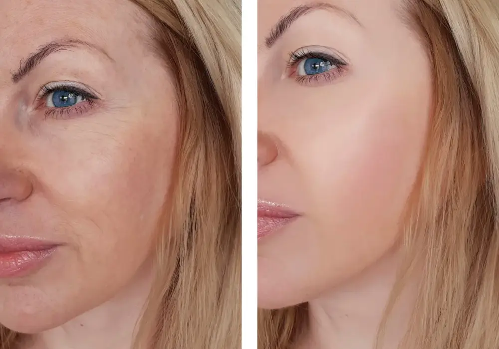 Peeling z retinolem: opinie, efekty i skutki uboczne zabiegu