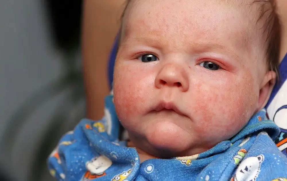 Alergia na nabiał u niemowląt objawy, które mogą zaniepokoić rodziców
