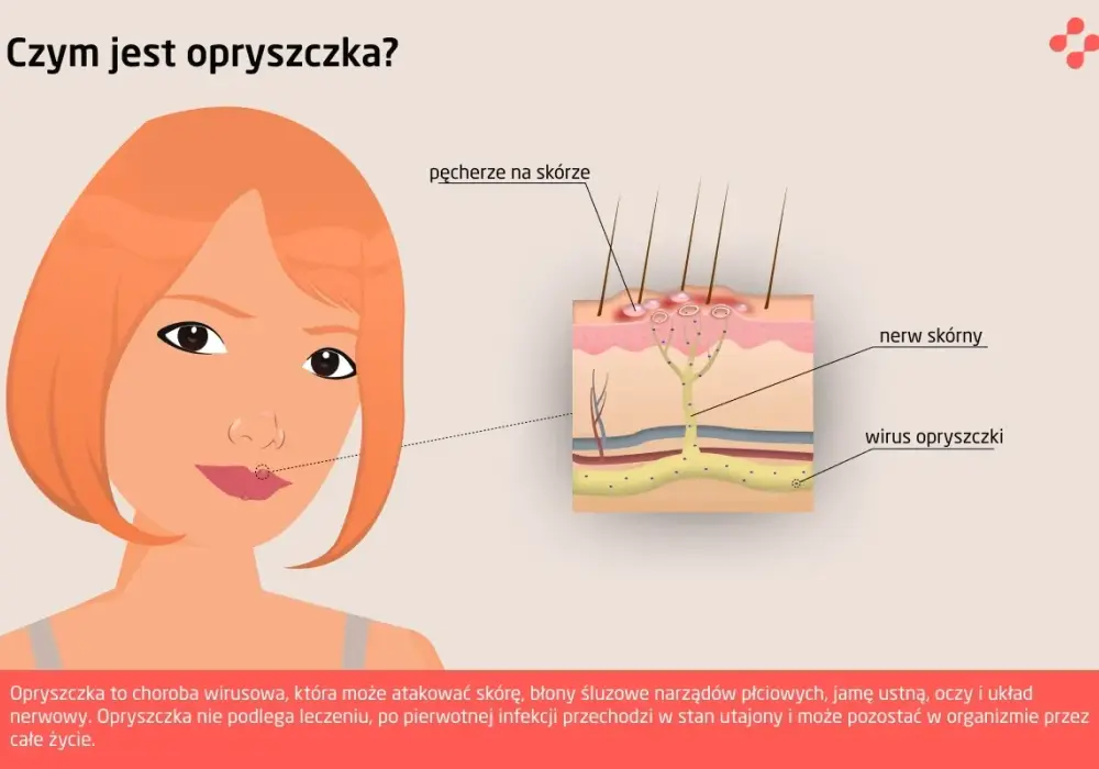 Opryszczka - pierwsze objawy i co robić, by szybko zwalczyć?