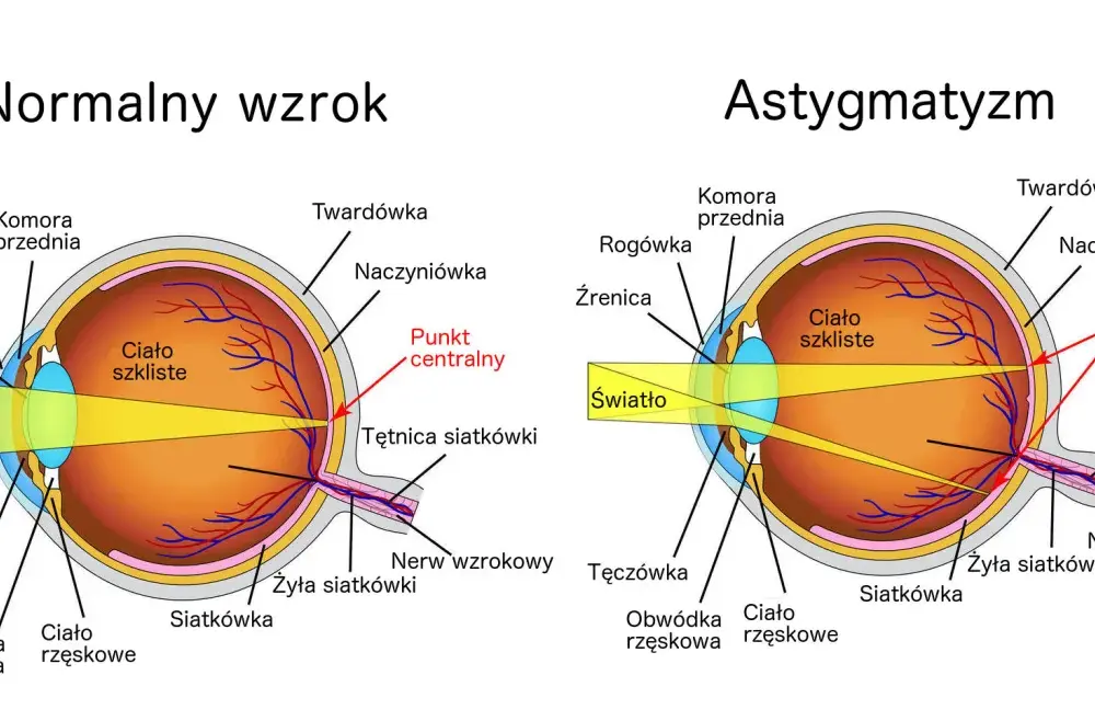 Astygmatyzm - Domowe sposoby - Co naprawdę działa?