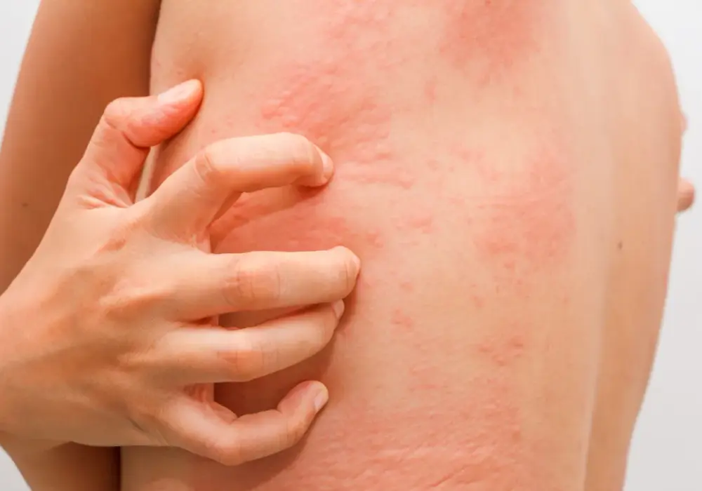 Reakcja skórna po lekach - kiedy to alergia, a kiedy infekcja?
