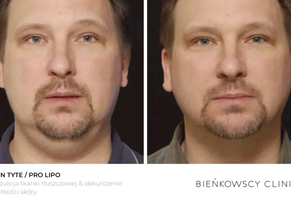 Lipoliza iniekcyjna - Czy to sposób na oporny tłuszcz?