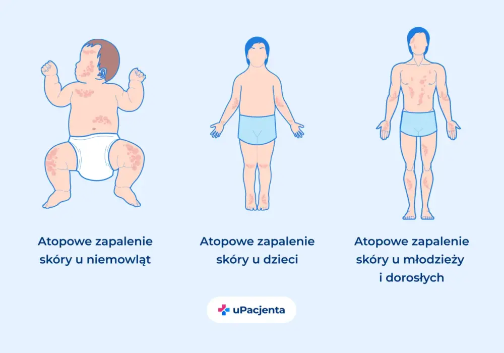AZS - objawy, przyczyny i pielęgnacja. Kiedy to nie tylko suchość?