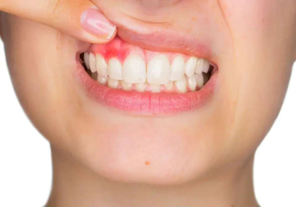 Czerwone dziąsła - co oznaczają i kiedy iść do dentysty