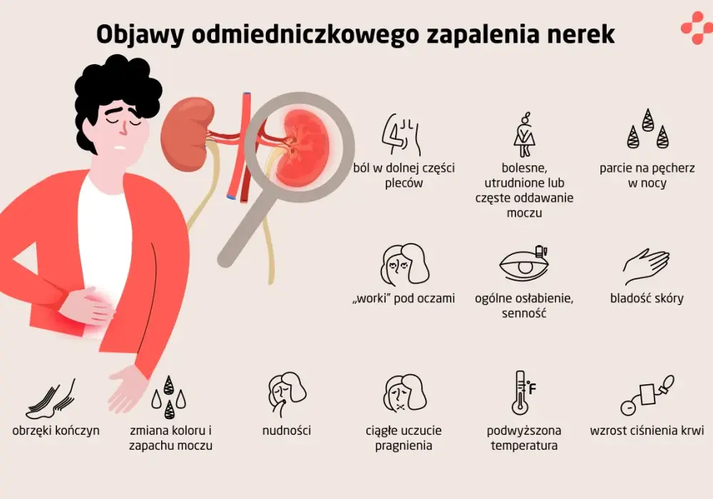 Odmiedniczkowe zapalenie nerek - Objawy, leczenie i zapobieganie