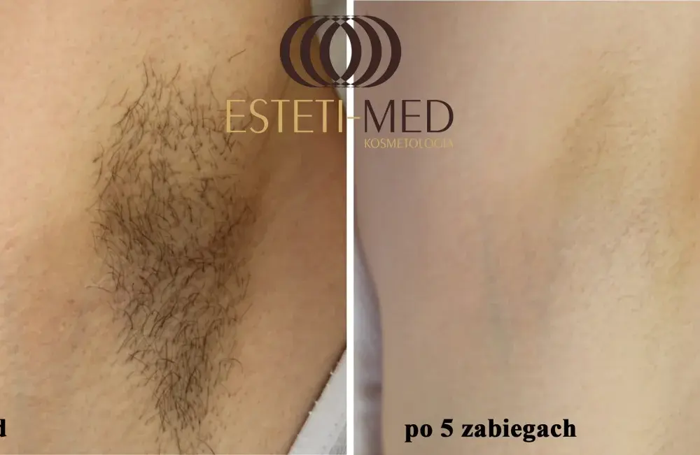 Depilacja laserowa - Co ile zabieg? Maksymalizuj efekty!