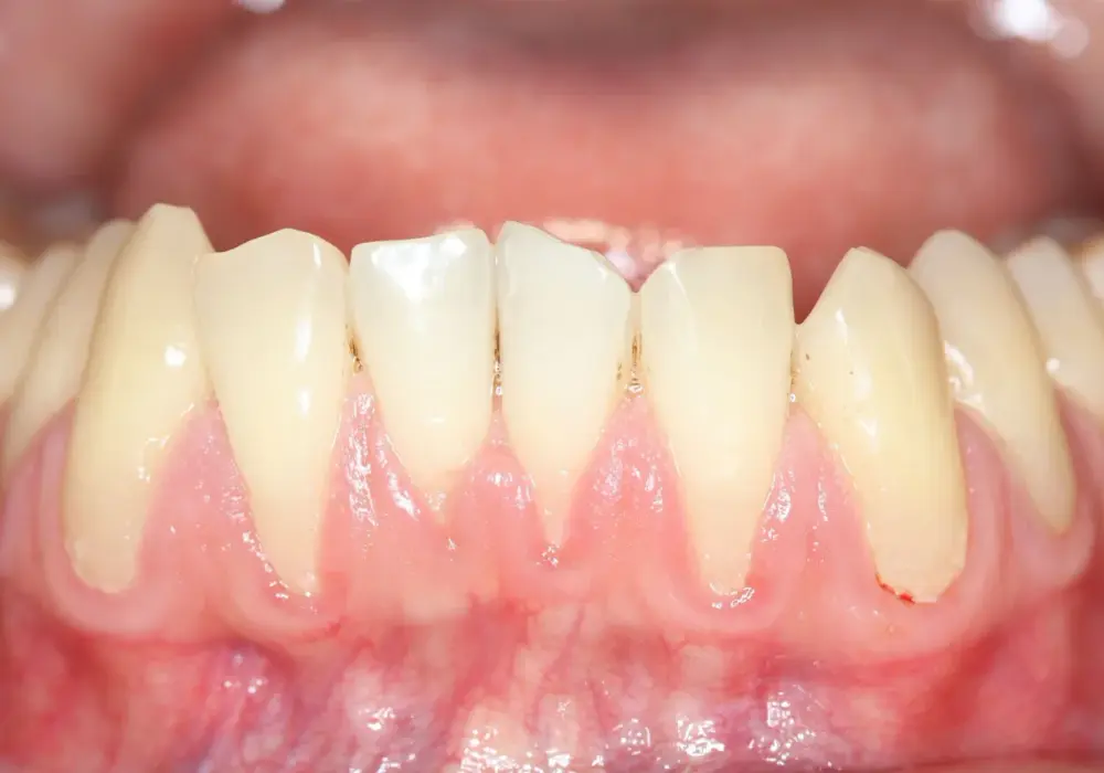 Białe dziąsła - Kiedy to grzybica, a kiedy leukoplakia?