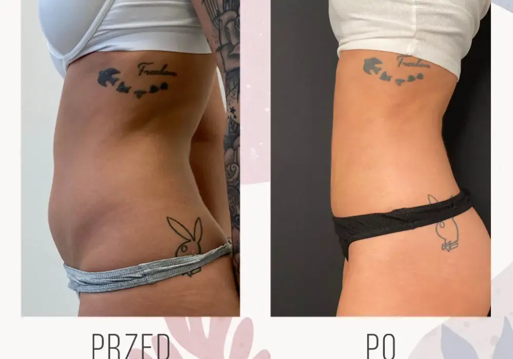 Na czym polega liposukcja? Poznaj skutki i metody tego zabiegu