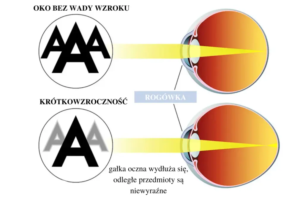 Soczewki na noc korygujące wzrok - Ostre widzenie w dzień?