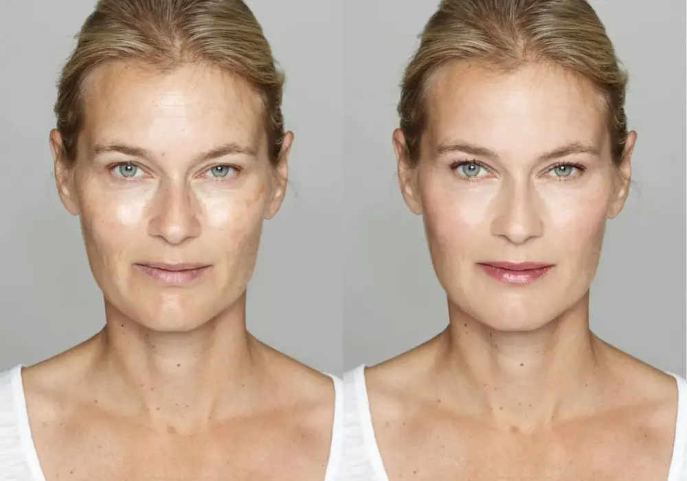 Ile kosztuje botox na czoło? Ceny w Polsce i co warto wiedzieć