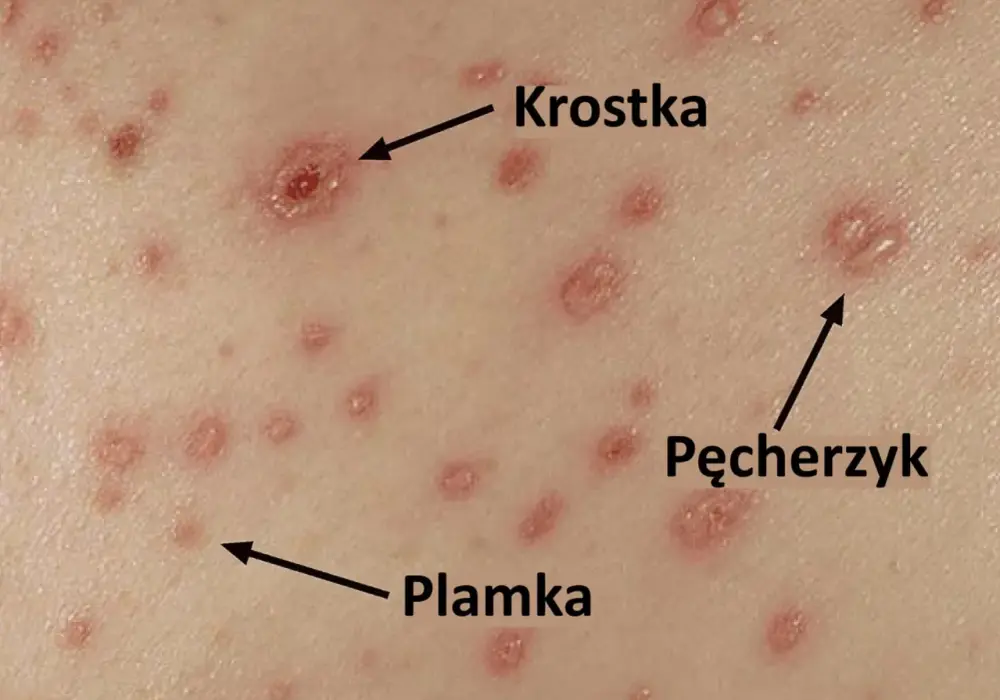Ospa wietrzna u dziecka - Jak wygląda wysypka krok po kroku?