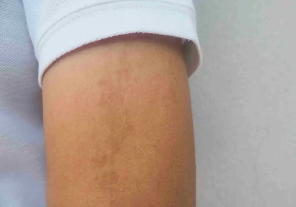 Plamy kawy z mlekiem - kiedy są łagodne i wymagają diagnostyki?