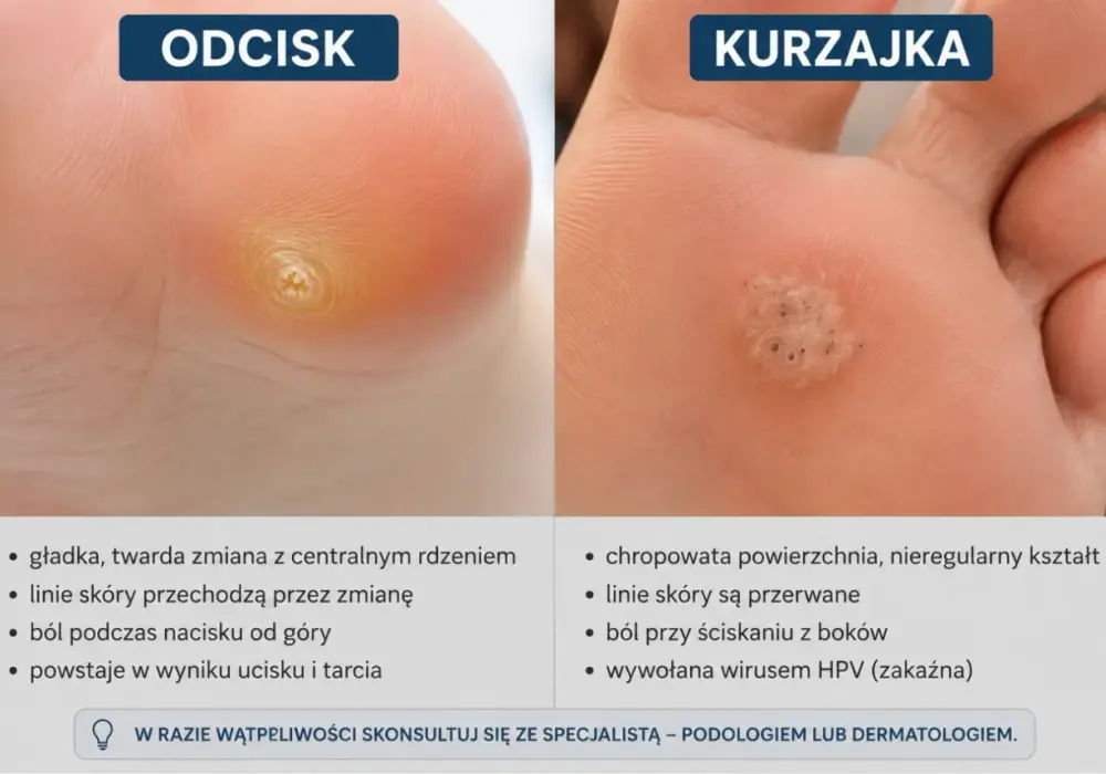 Kurzajka czy odcisk? Jak rozpoznać zmianę na stopie