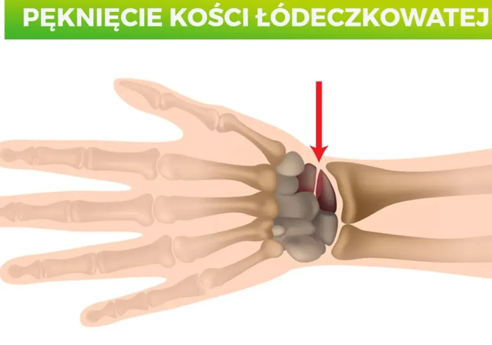 Kości nadgarstka - budowa, funkcja i najczęstsze błędy