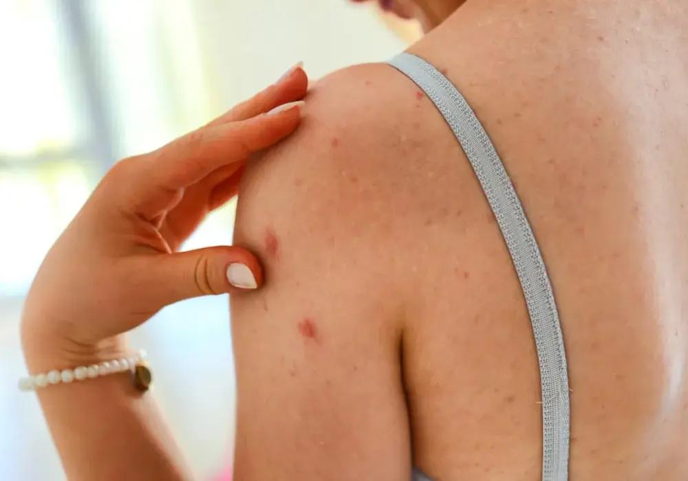 Łupież różowy Giberta - jak wygląda i kiedy iść do dermatologa
