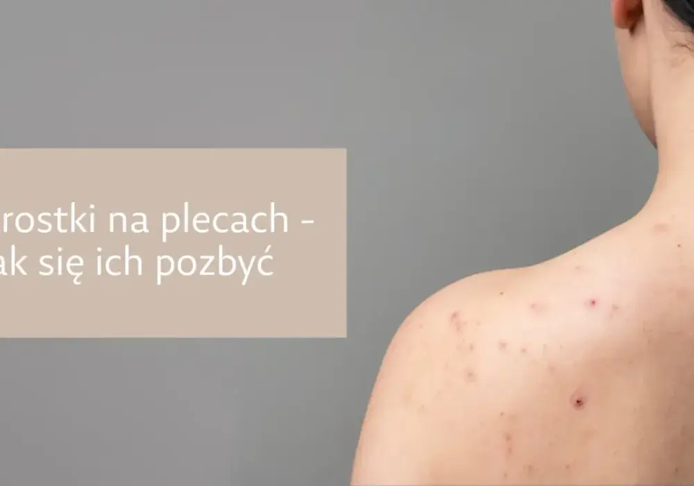 Pryszcze na plecach od czego? Odkryj przyczyny i skuteczne rozwiązania