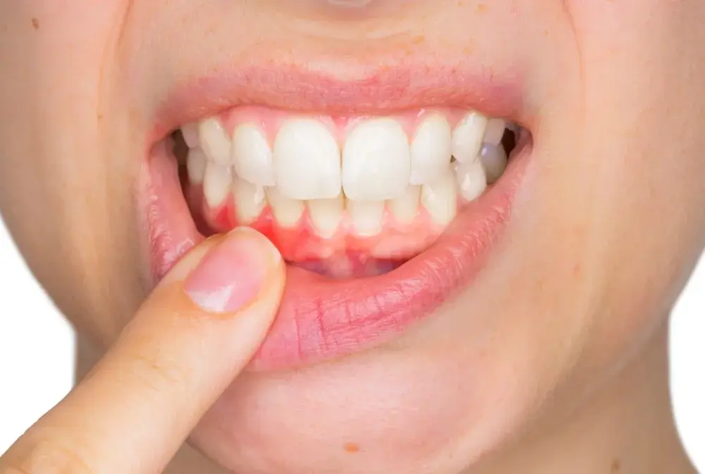 Poparzone dziąsła - co zrobić i kiedy iść do dentysty