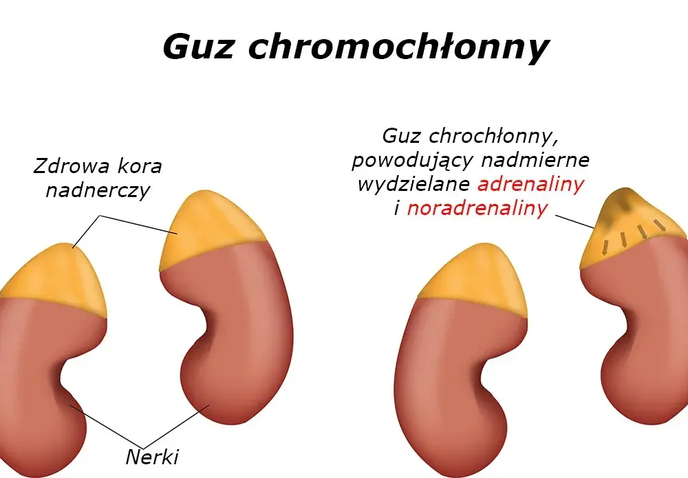 Guz nadnercza do jakiego lekarza? Kluczowe informacje o specjalistach