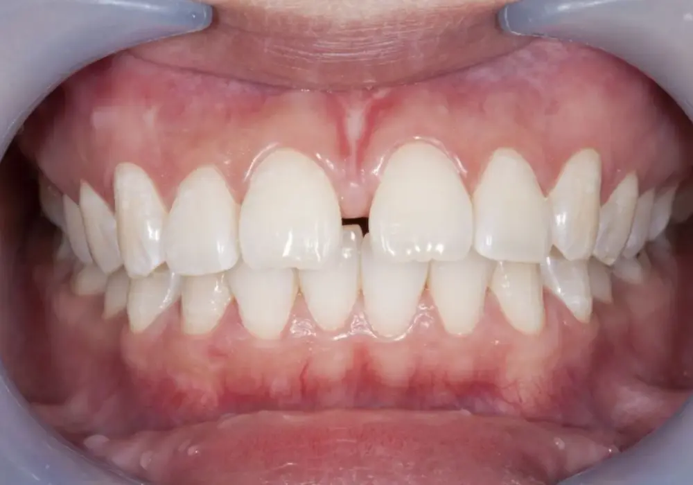 Diastema między zębami - kiedy to norma, a kiedy problem?
