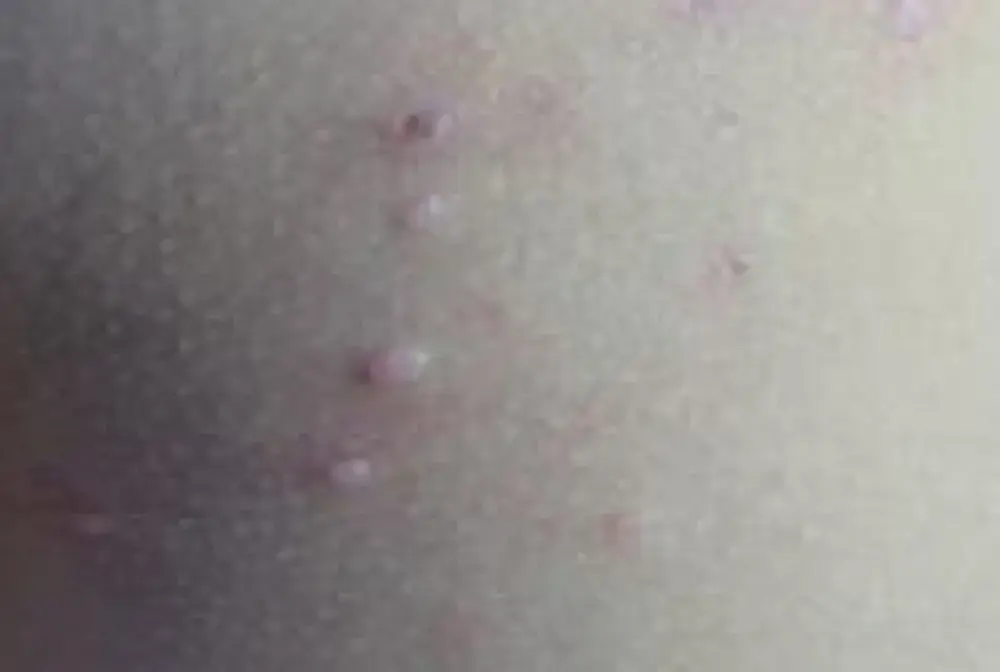 Skuteczne sposoby na mięczaka zakaźnego - 7 najlepszych metod leczenia