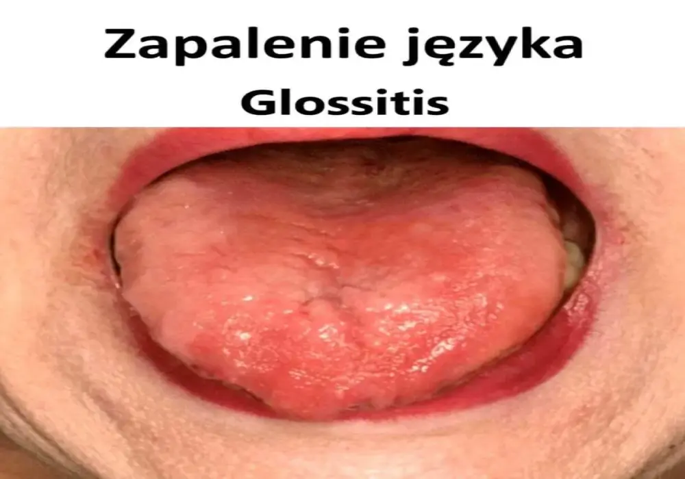 Zapalenie języka - Leki bez recepty i kiedy do lekarza?
