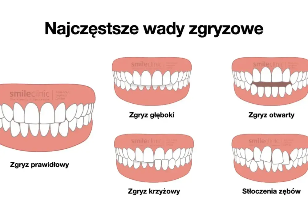 Zgryz, okluzja, wada zgryzu - poznaj różnice i leczenie!