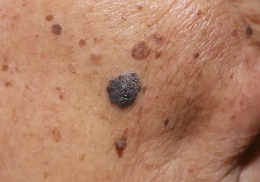 Suche plamy na skórze - co oznaczają i kiedy iść do dermatologa?
