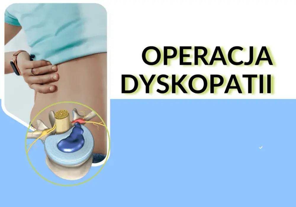 Dyskopatia - kiedy operacja, a kiedy rehabilitacja?