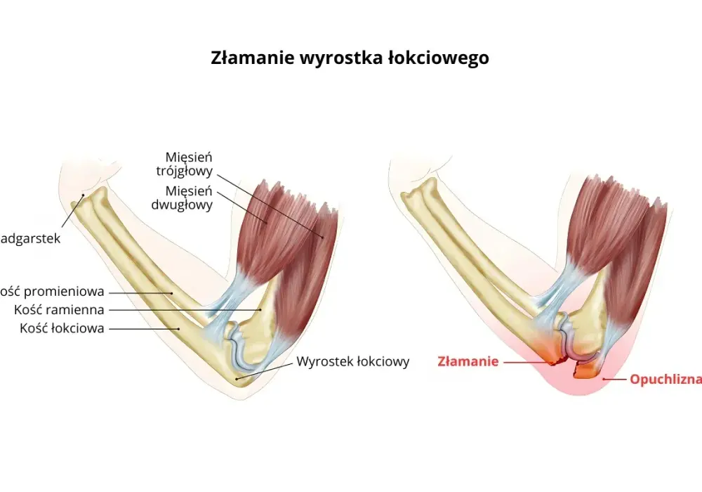 Łokieć - budowa, ruch i problemy. Poznaj swój staw!
