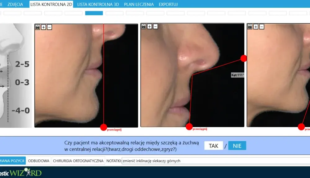 Klikająca szczęka - Kiedy to normalne, a kiedy do dentysty?