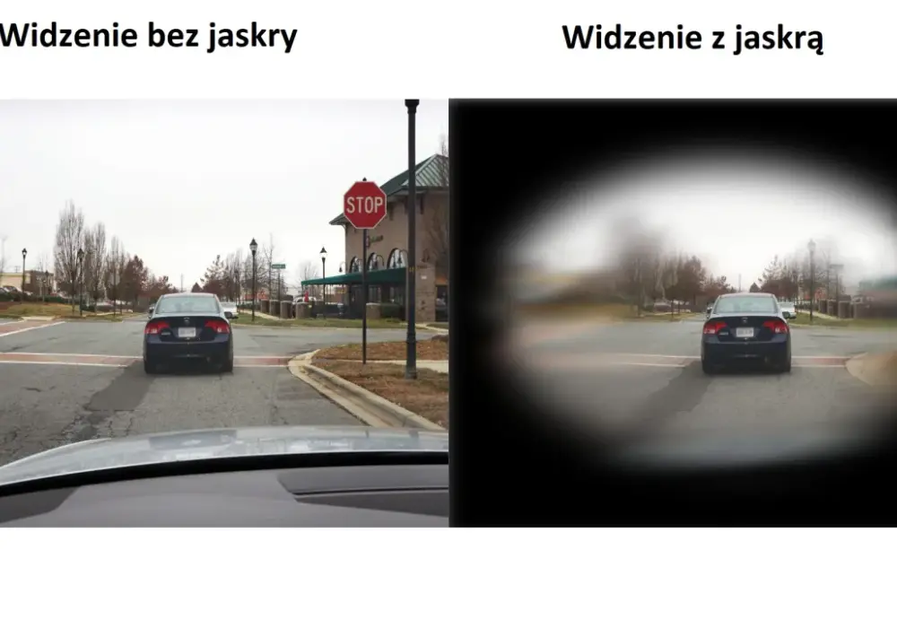 Jaskra - Jak zmienia się widzenie - Zobacz symulację