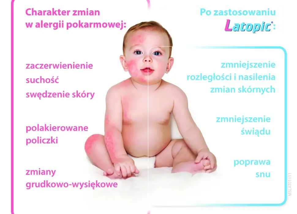 Objawy AZS u niemowlaka: Jak rozpoznać i złagodzić uciążliwe dolegliwości