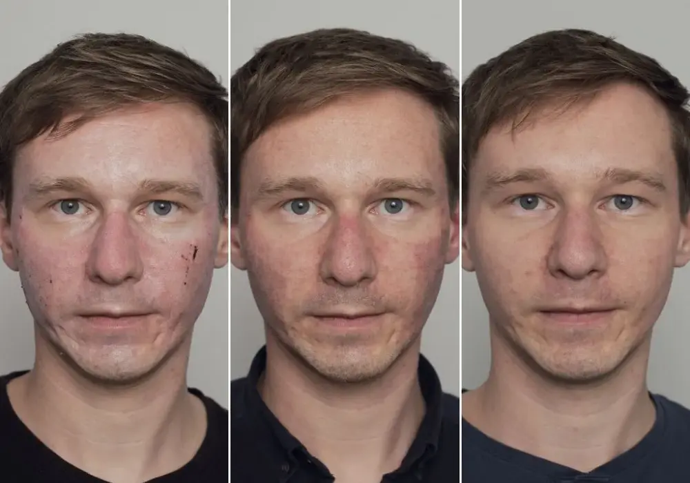 Jak wygląda twarz po laserze frakcyjnym? Efekty, które zaskakują