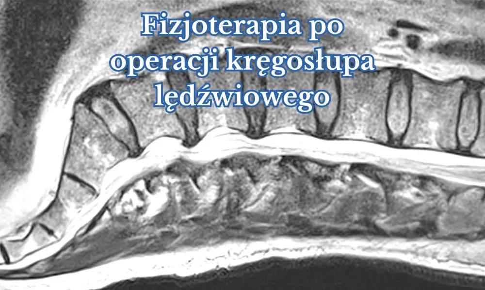 Czy fizjoterapia pomaga na kręgosłup? Odkryj skuteczne metody leczenia