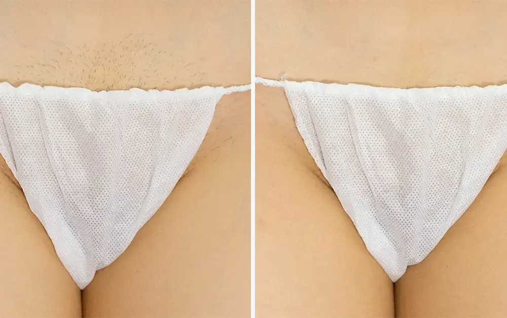 Bikini głębokie co to? Poznaj metody depilacji i efekty