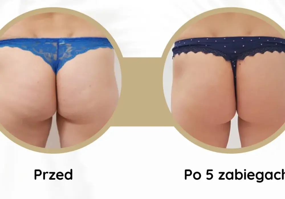 Endermologia - efekty po 5 zabiegach? Sprawdź, co realne!
