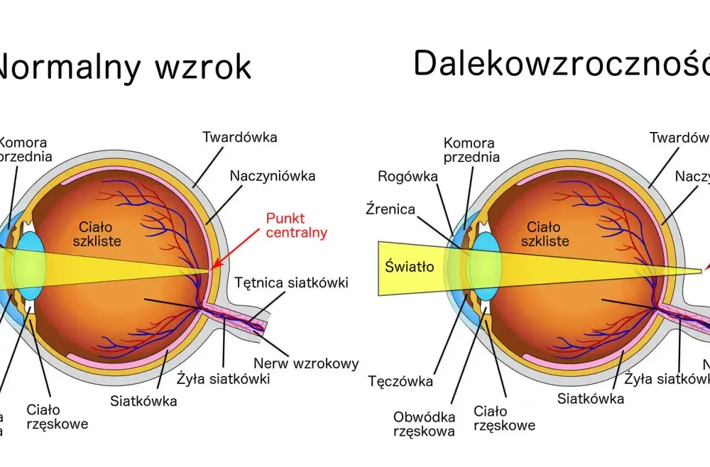 Nadwzroczność - Podstępna wada wzroku? Rozpoznaj i koryguj!