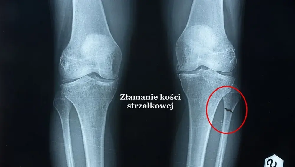 Skuteczne metody na ból po złamaniu – ulga i szybkie leczenie